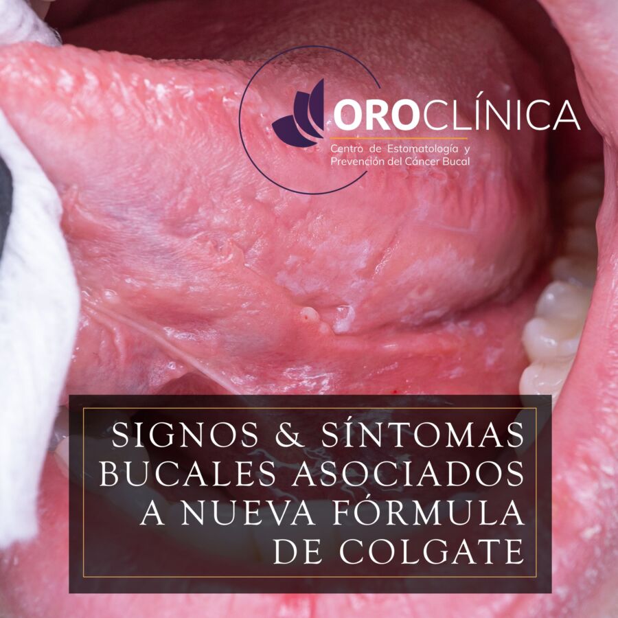 Reacciones orales asociadas con Colgate Clean Mint – OROCLÍNICA Publicación educativa de OROCLÍNICA sobre lesiones y reacciones adversas de la mucosa oral asociadas con el uso de una nueva formulación de pasta dental Colgate.