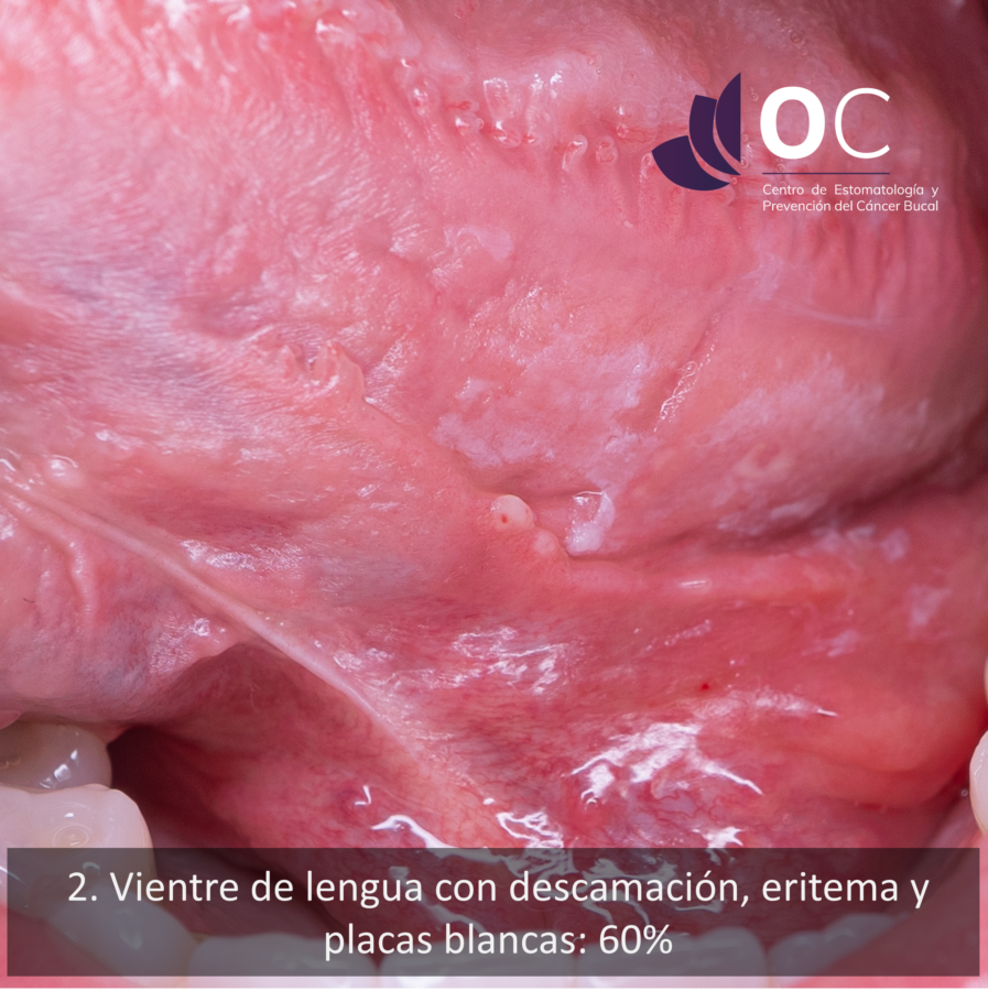 Fotografía clínica de la superficie ventral de la lengua con áreas de eritema, descamación y placas blanquecinas, compatibles con una posible reacción de contacto.